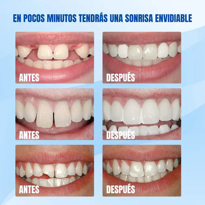 RESINA DENTAL: Dile Adiós a eso Dientes rotos🦷